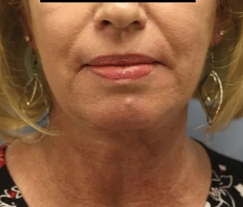 Moraitis hp before and after after